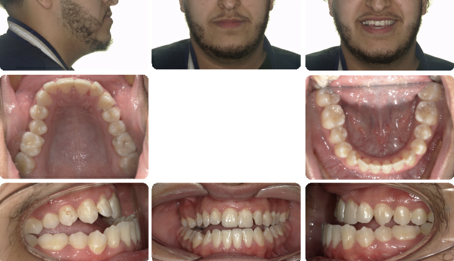 Class III Surgical — Pre-treatment