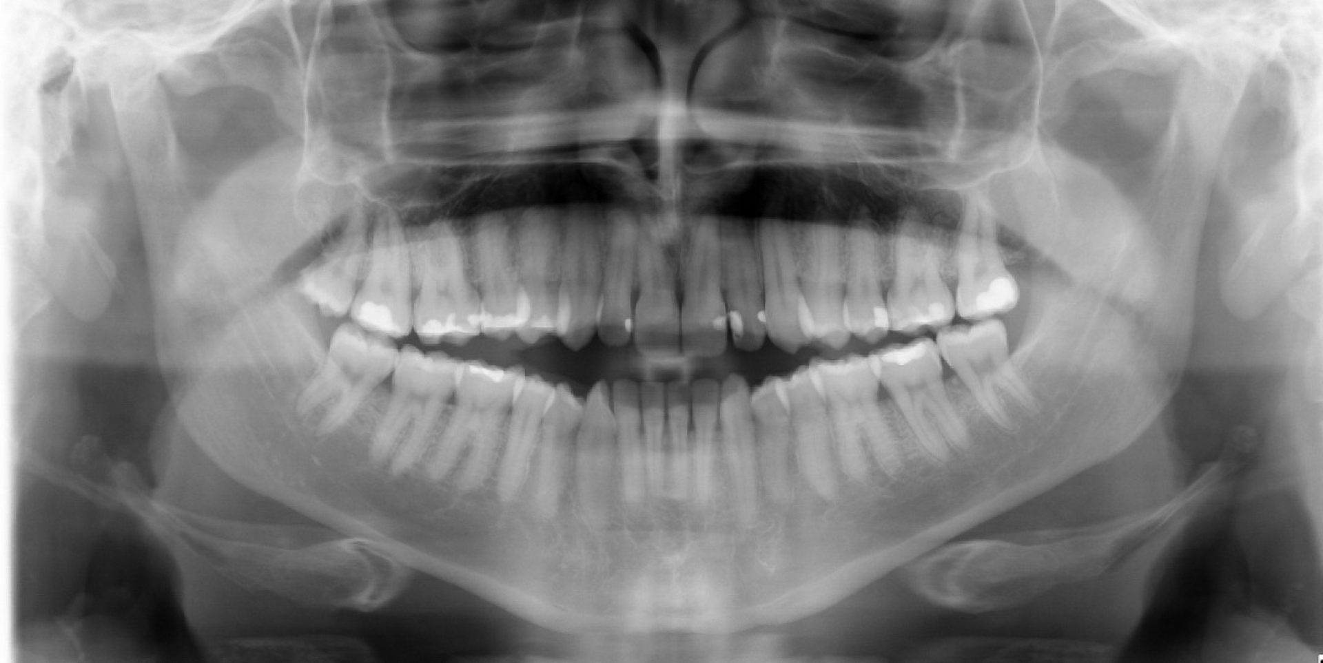 Class III Surgical — Panoramic radiograph