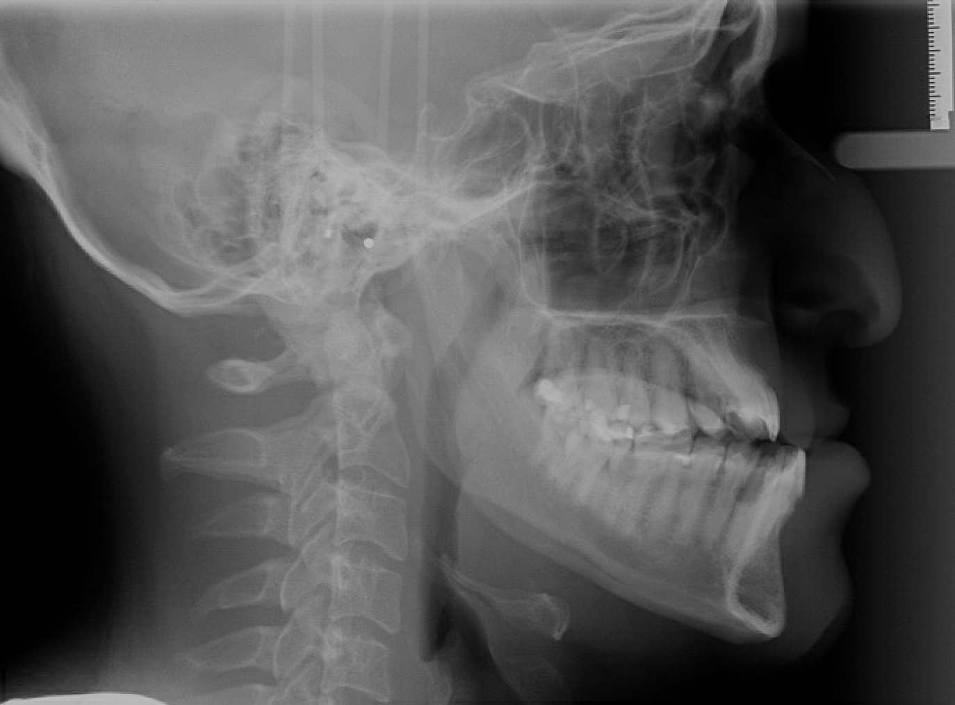 Class III Surgical — Cephalometric radiograph