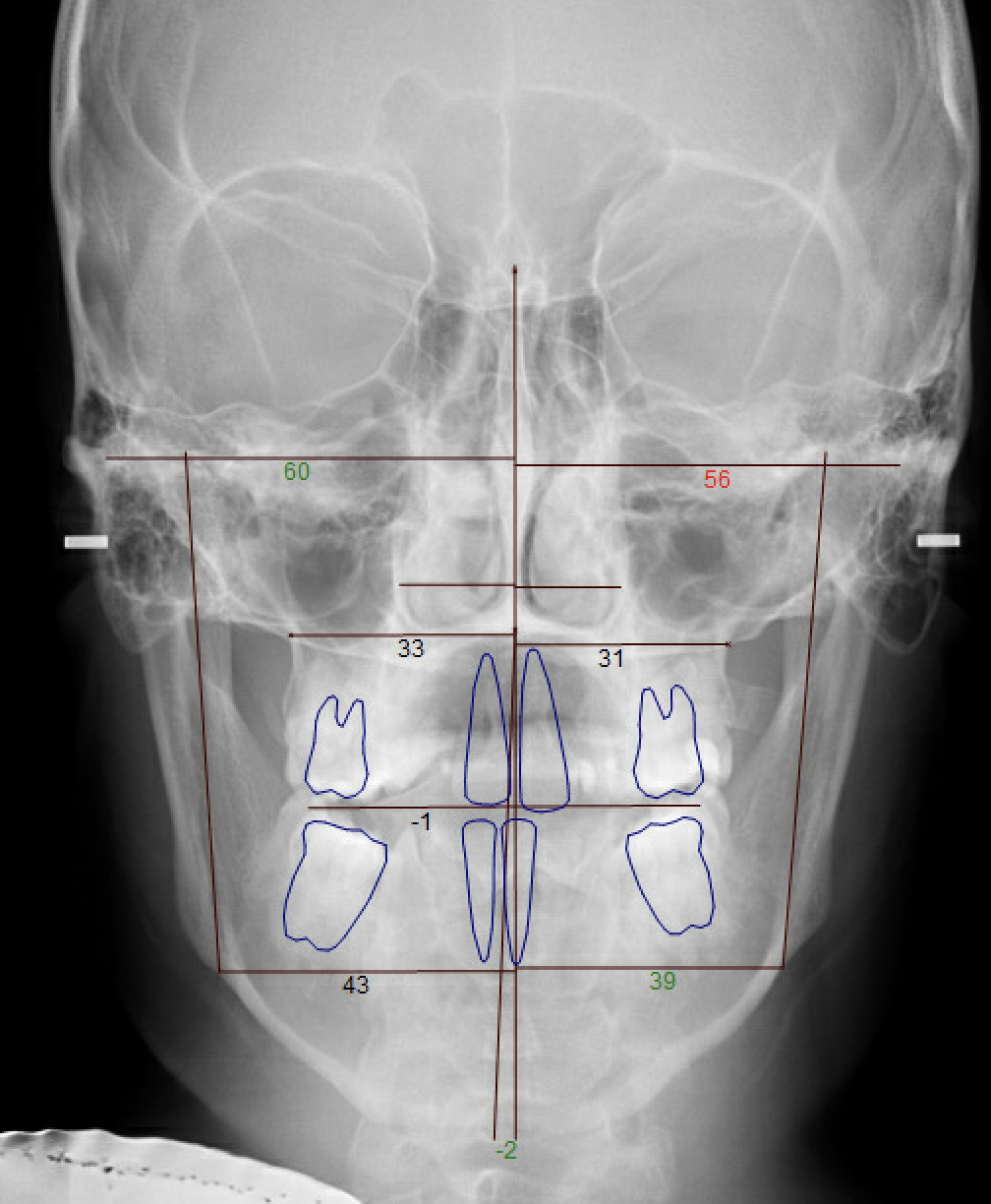 Class III Surgical — Frontal cephalometric