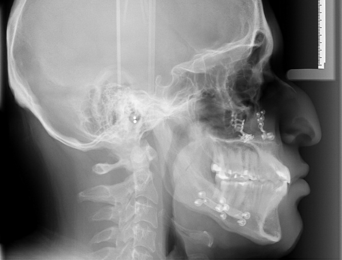 Class III Surgical — Final cephalometric radiograph