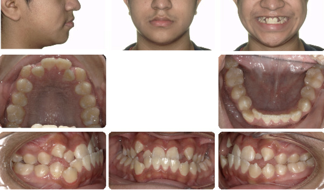 Class III — Pre-treatment
