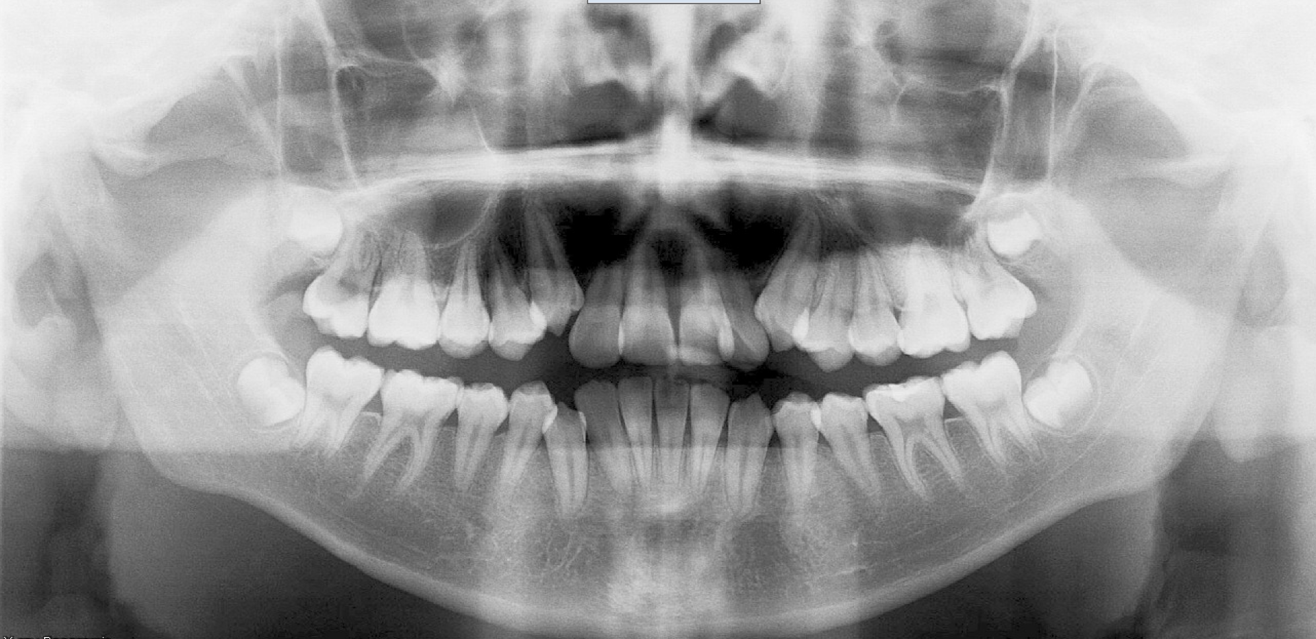 Class III — Panoramic radiograph