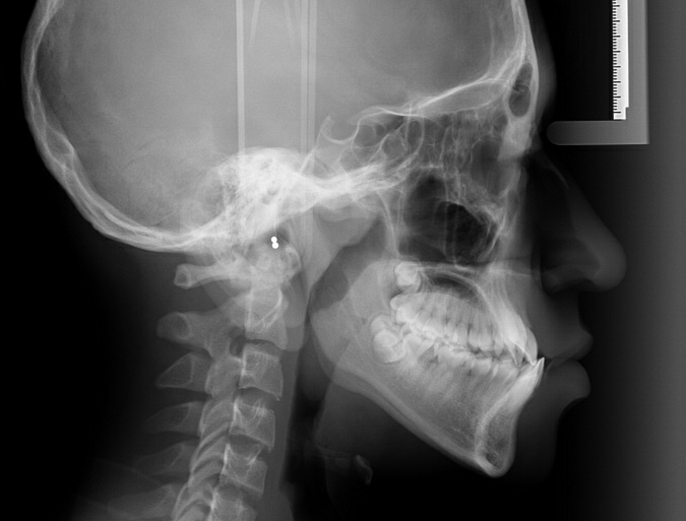 Class III — Cephalometric radiograph