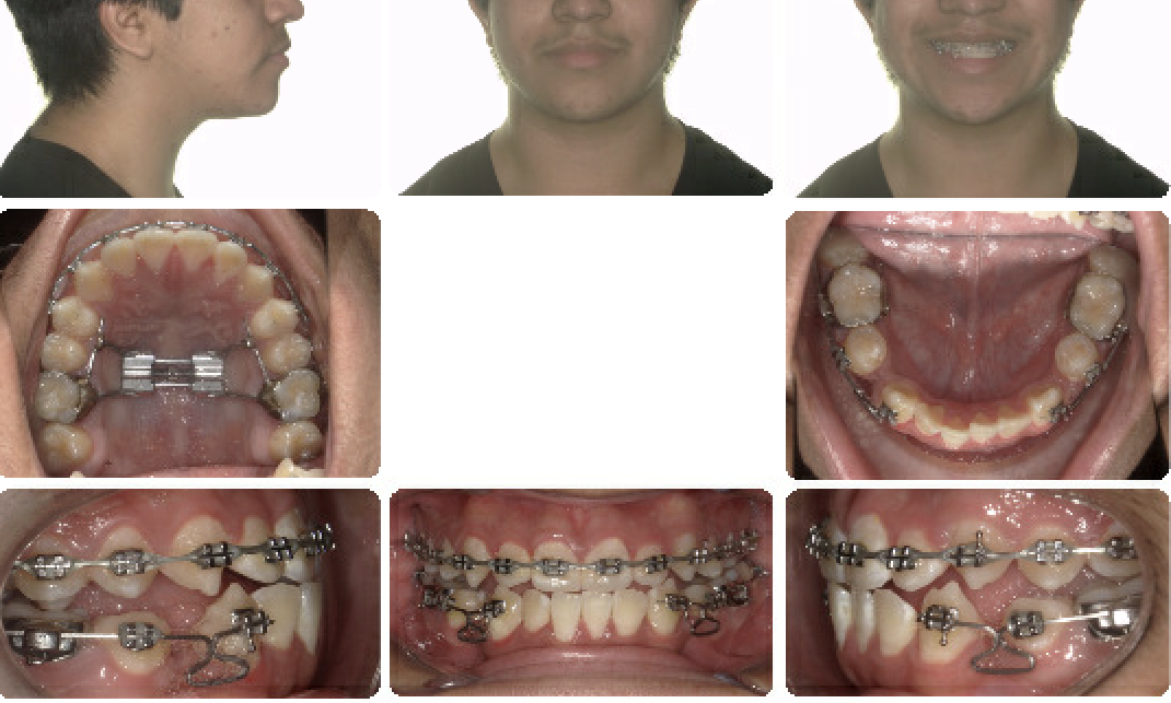 Class III — In treatment
