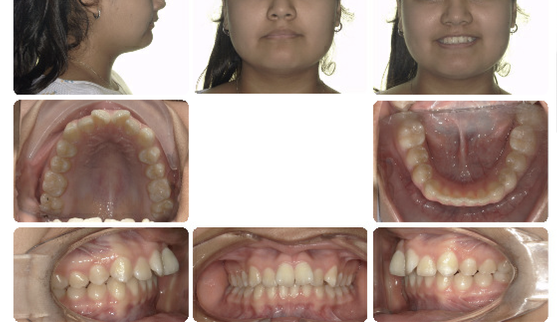 Class II correction — Herbst — Pre-treatment
