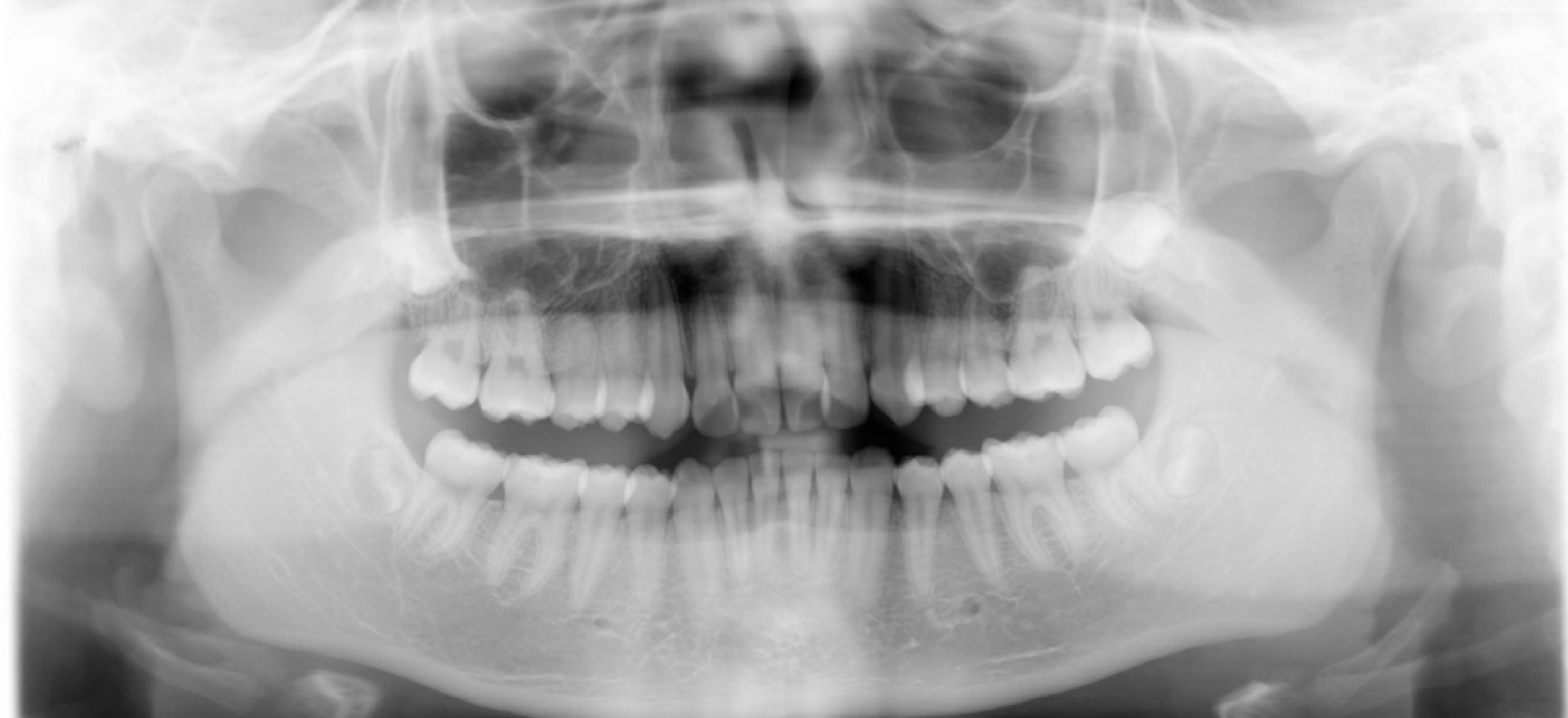 Class II correction — Herbst — Panoramic radiograph