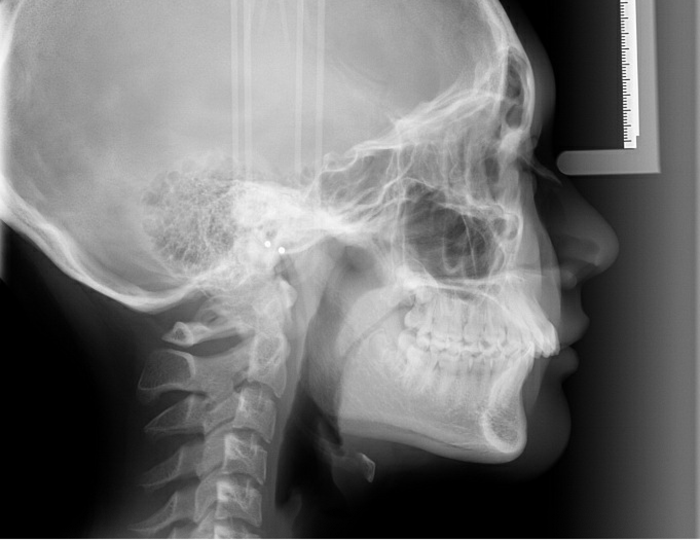 Class II correction — Herbst — Cephalometric radiograph