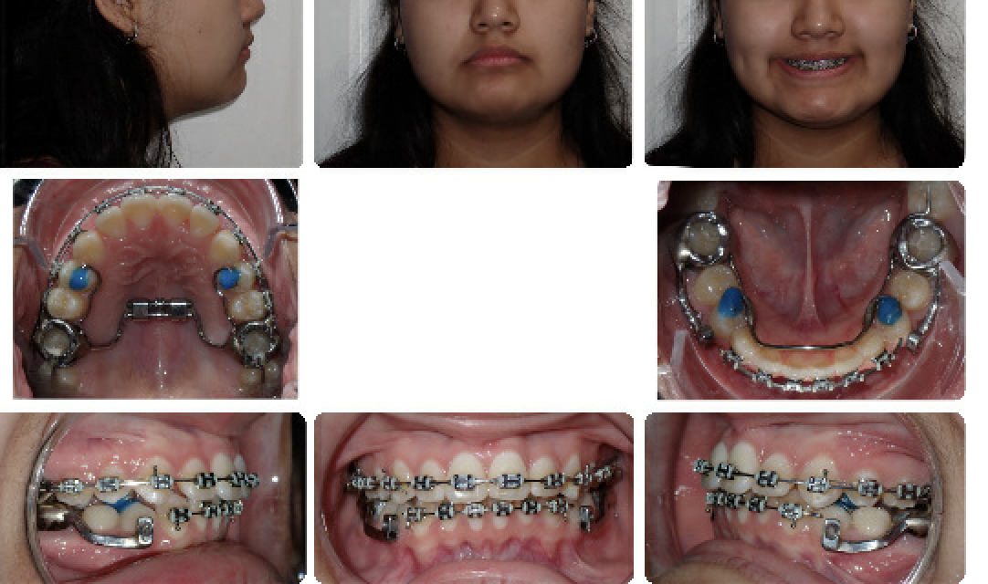 Class II correction — Herbst — In treatment
