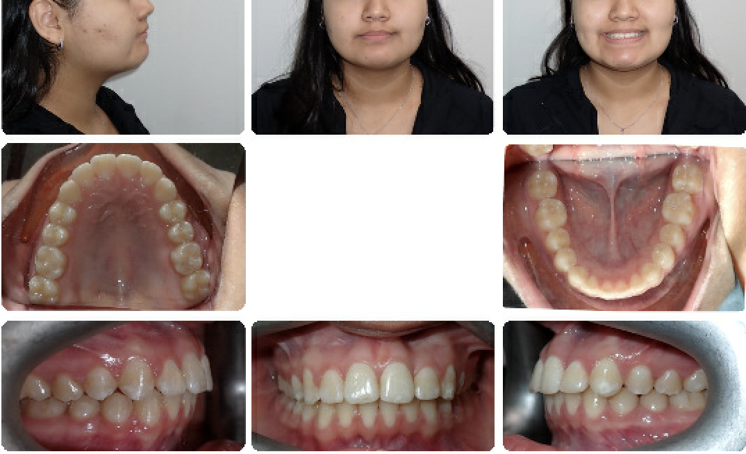 Class II correction — Herbst — Final