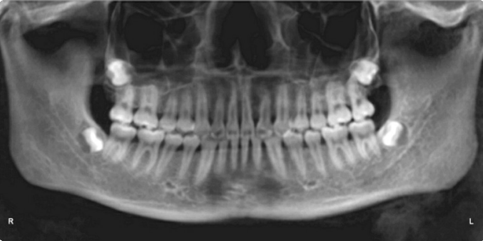 Class II correction — Herbst — Final panoramic radiograph