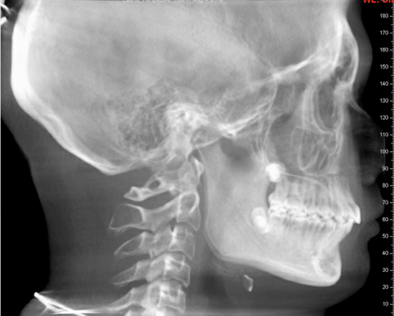 Class II correction — Herbst — Final cephalometric radiograph