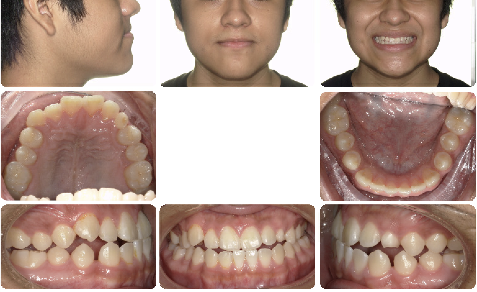 Impacted Canine — Pre-treatment
