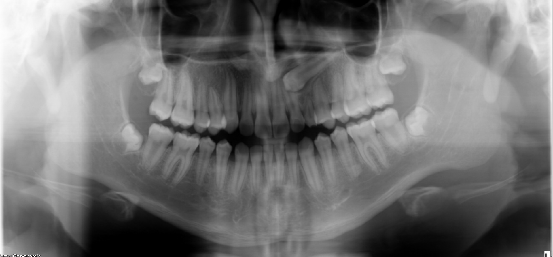 Impacted Canine — Panoramic radiograph