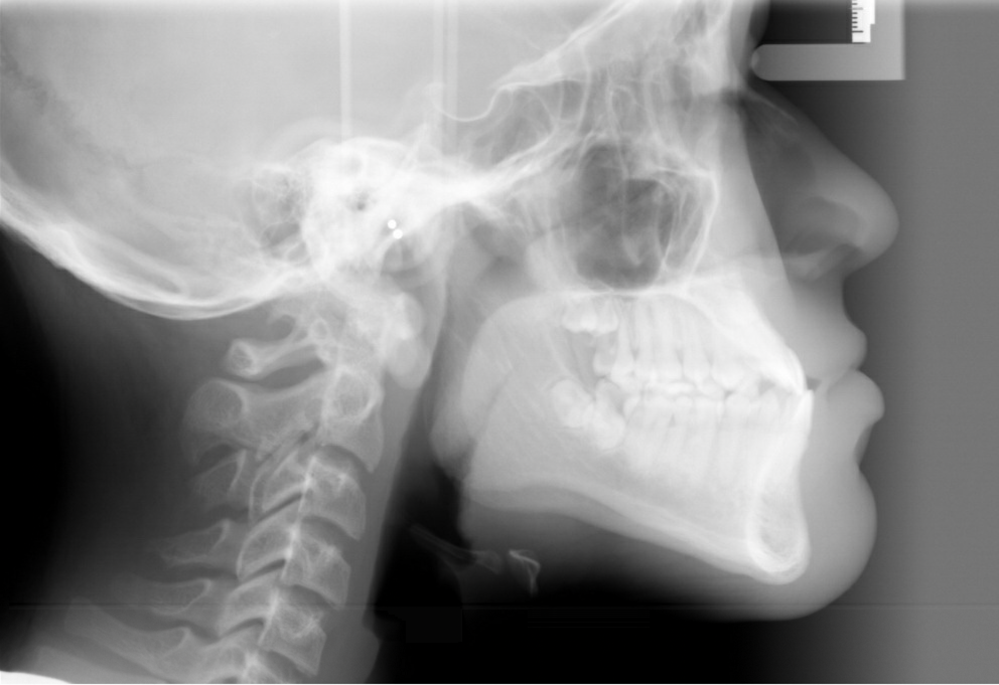 Impacted Canine — Cephalometric radiograph