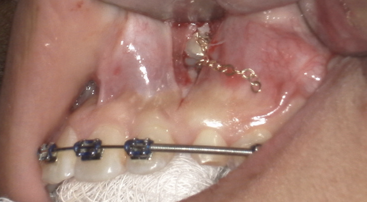 Impacted Canine — In treatment