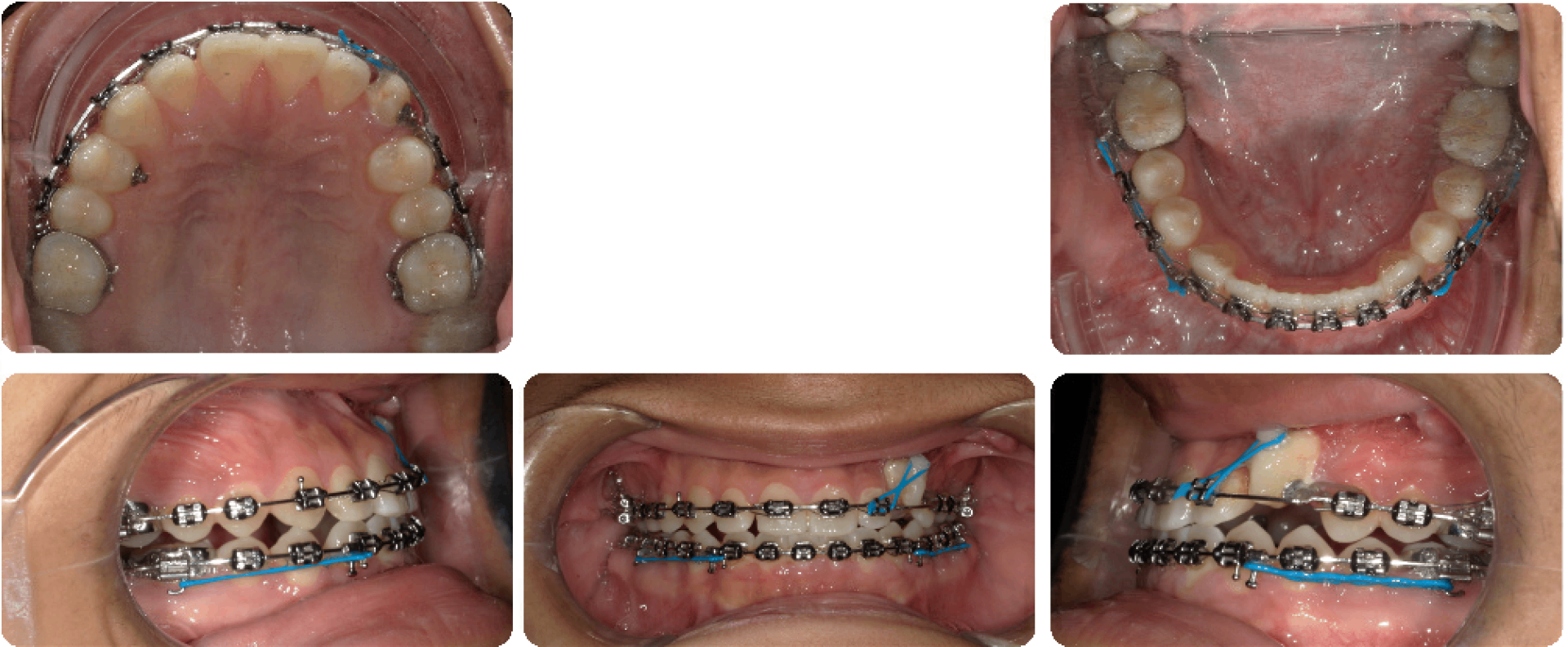 Impacted Canine — In treatment