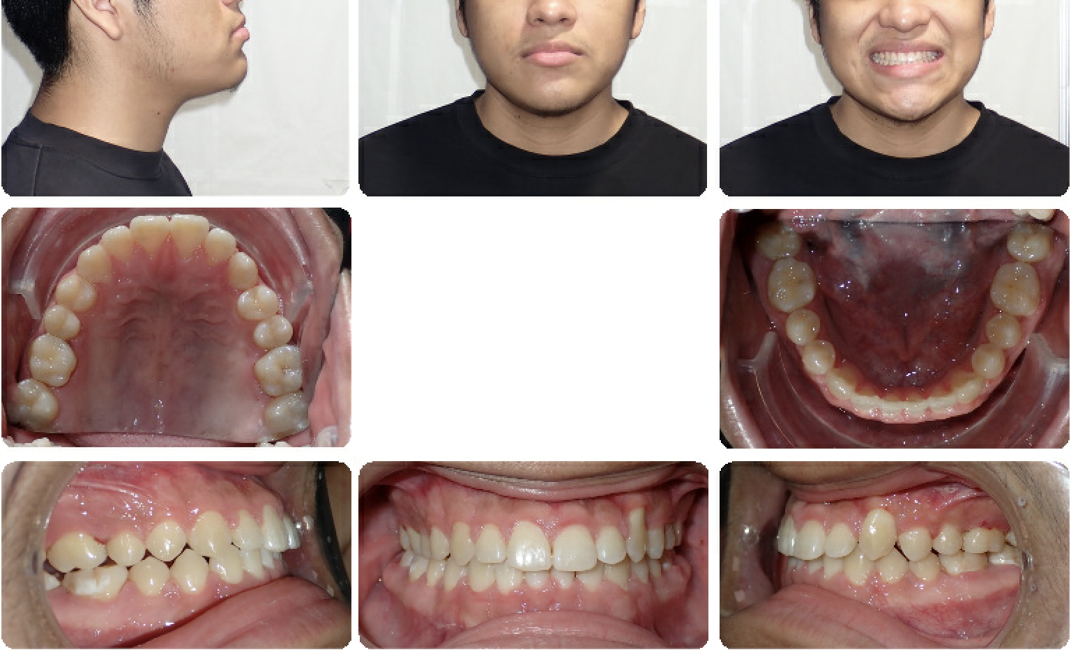 Impacted Canine — Final