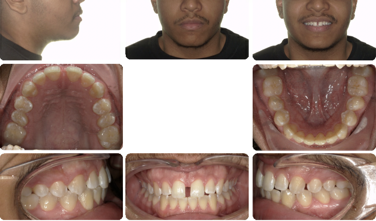 Spacing - Invisalign — Pre-treatment