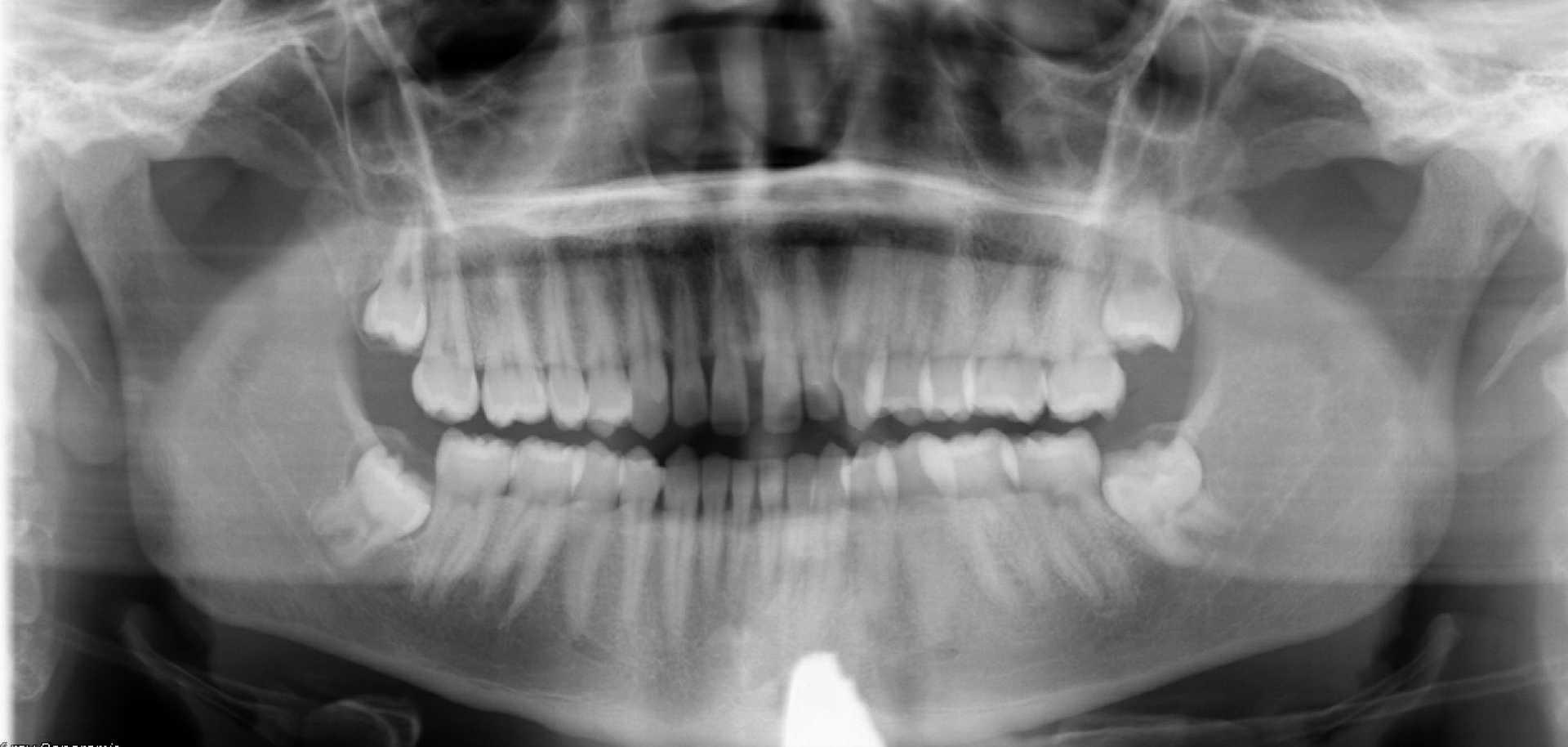 Spacing - Invisalign — Panoramic radiograph