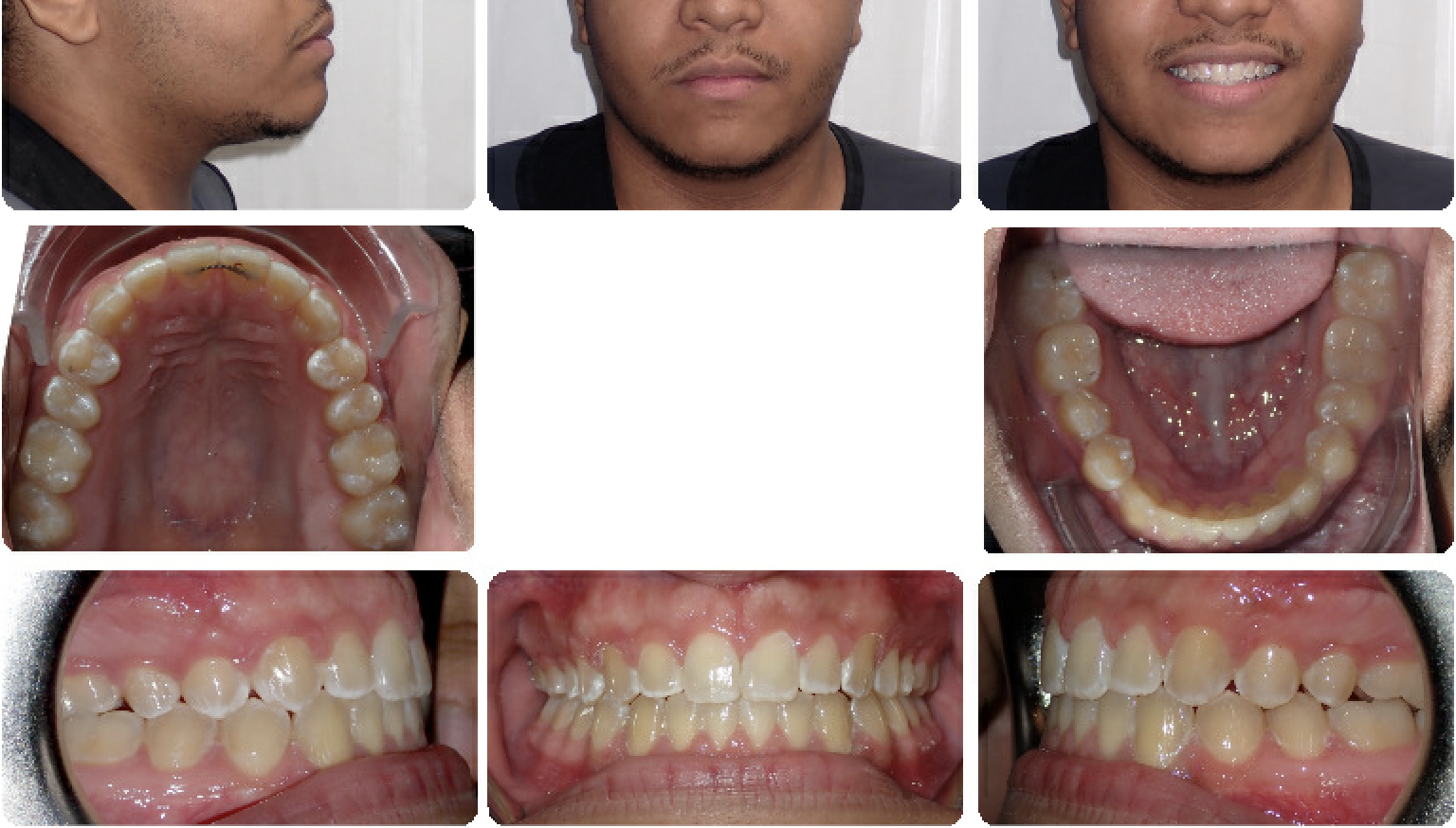 Spacing - Invisalign — Final