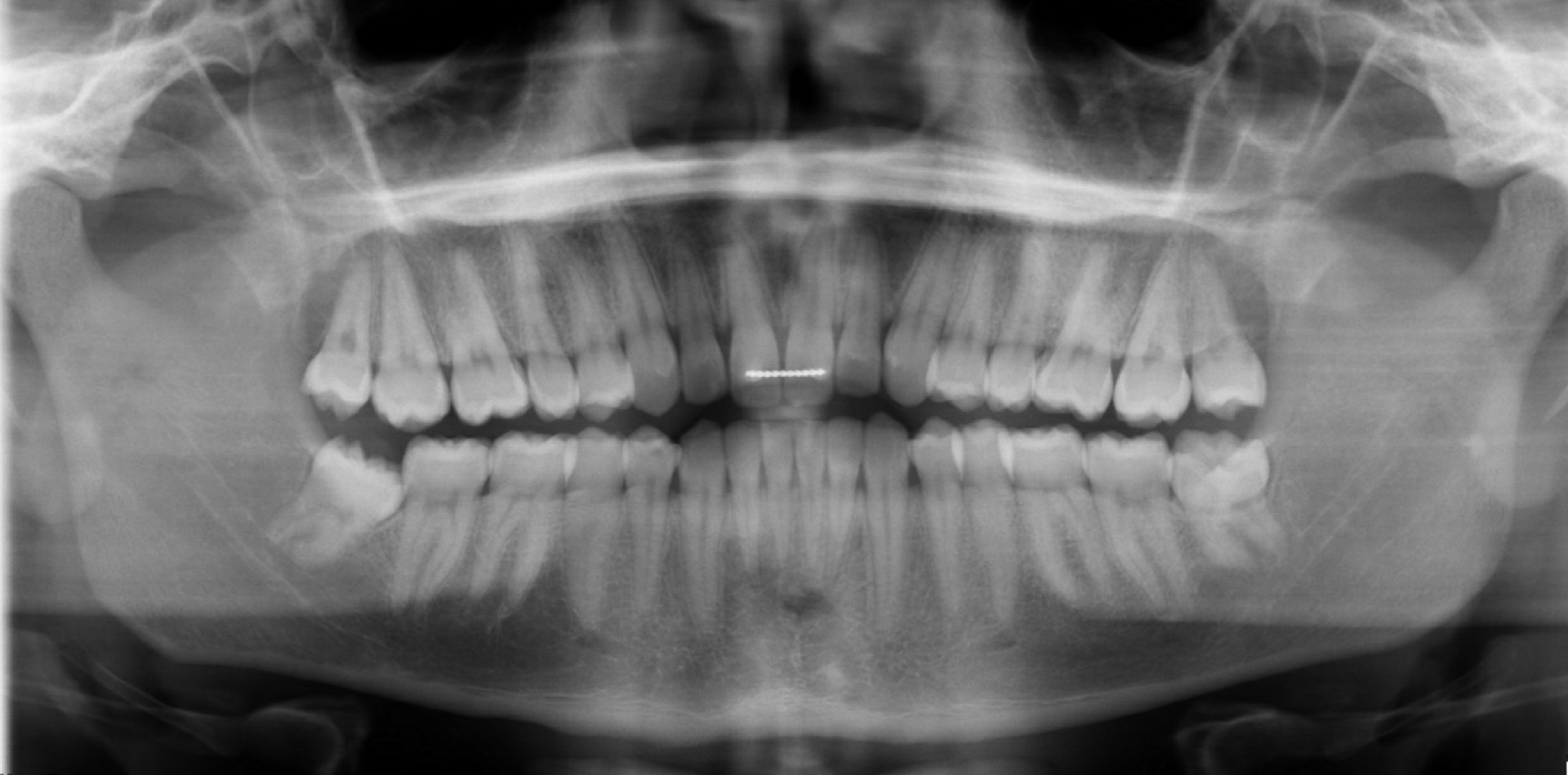 Spacing - Invisalign — Final panoramic radiograph